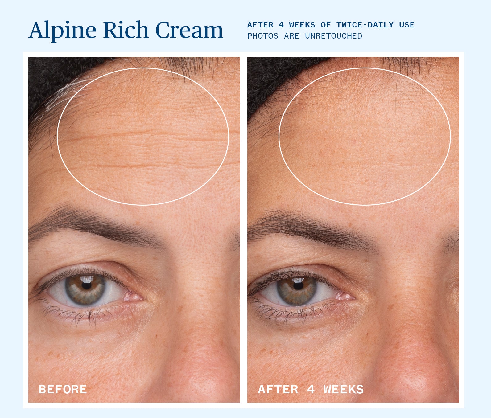 Alpine Rich Cream before and after split screen after 4 weeks of twice daily use.  Photos are unretouched.  Before shows some wrinkles on the person's forehead.  After image shows little to none.